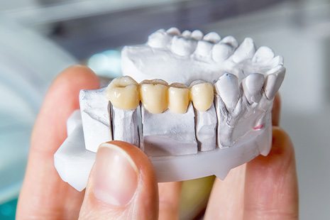 A model showing dental bridge in Abilene