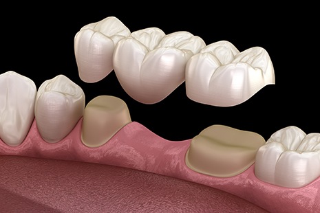 3D graphic of traditional dental bridge