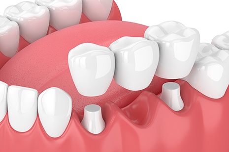 3D graphic of implant bridge