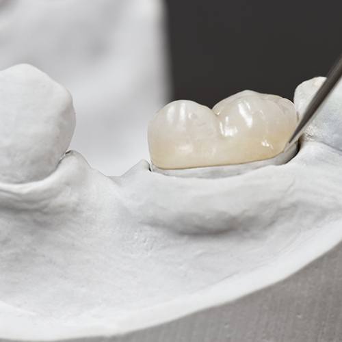 Example of dental crowns in Abilene