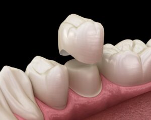 Digital rendering of crown fitting over tooth.
